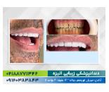 دندانپزشکی زیبایی در گاندی  تهران