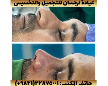 أفضل جراح أنف في إيران