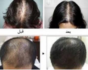 درمان ریزش مو با مزوتراپی در منطقه 14