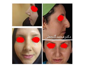 جراحی زیبایی بینی در شرق تهران